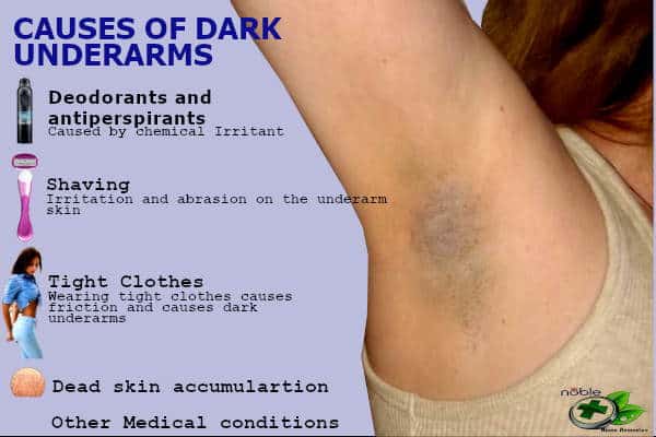 What Causes Dark Skin Under Arms