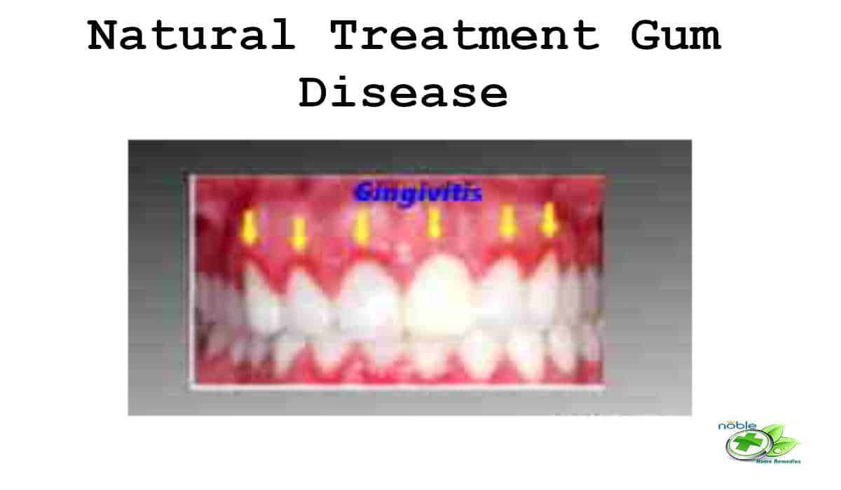 Top 7 Natural Treatment Gum Disease 2017 Update - 