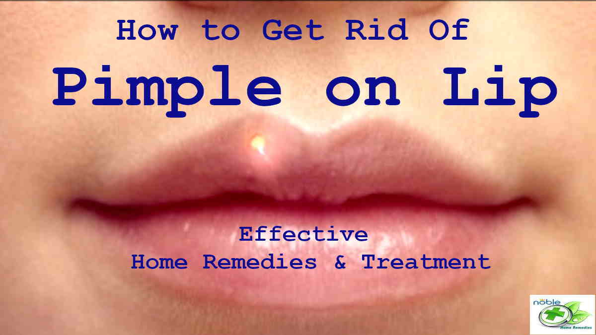 How To Get Rid Of A Pimple On Lip Best 9 Remedies And Treatments