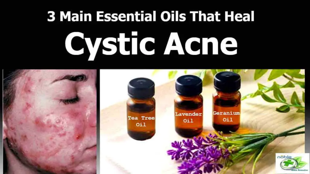 Essential Oils for Cystic Acne