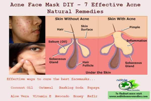 Acne Face Mask DIY – 7 Effective Acne Natural Remedies