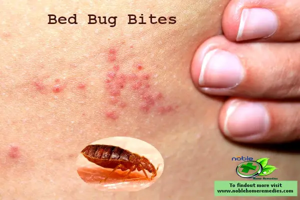 Bed Bug Bites- Tiny pests suck blood form the skin