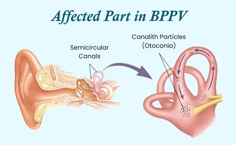 Benign Paroxysmal Positional Vertigo