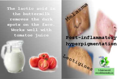 Buttermilk removes Dark Spots on Face