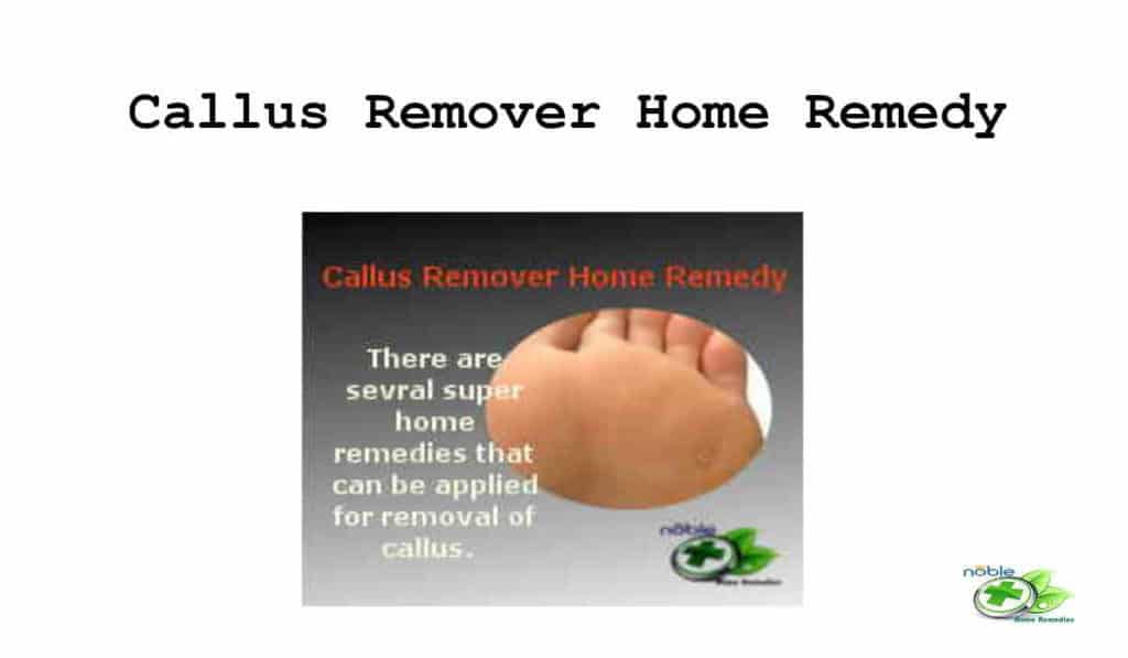 Get Rid of Calluses on Feet