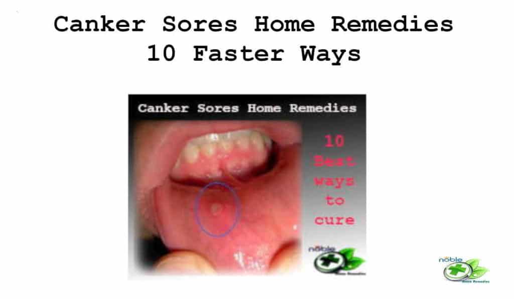 Canker Sores Home Remedies - 10 Faster Ways