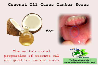 Canker sores home remedies coconut oil