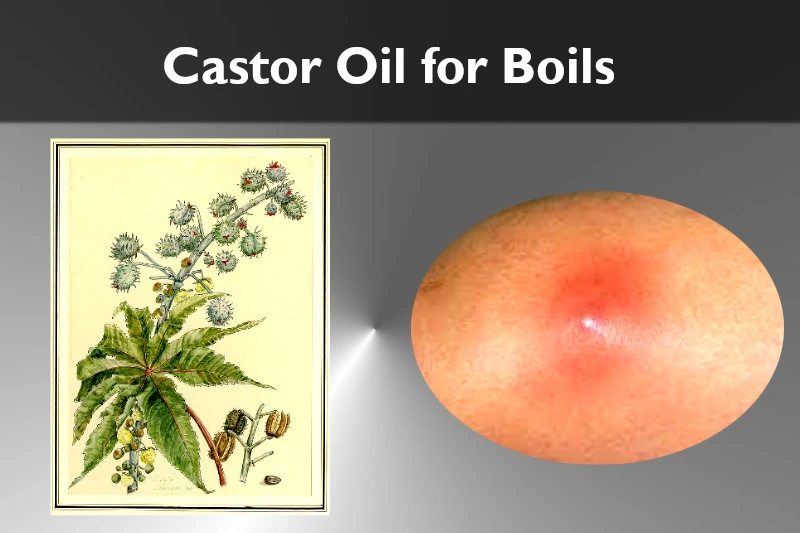 castor oil for boils an effective home remedy