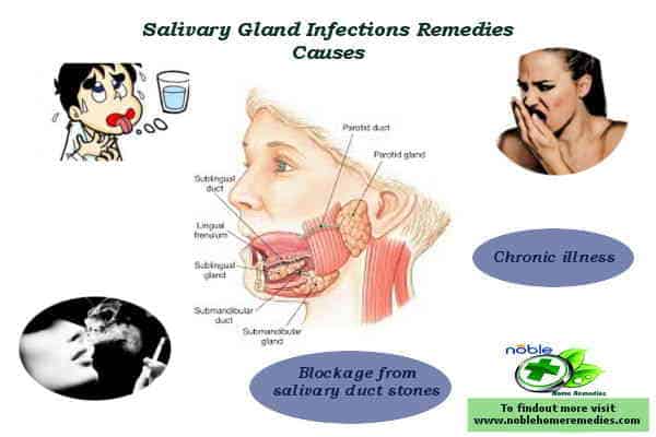 Cause of Bacterial Salivary gland infections