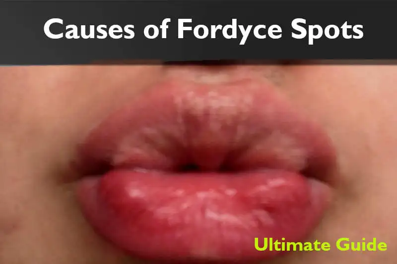 causes of Fordyce spots guide