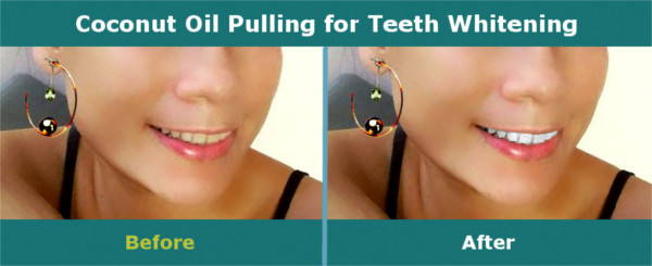 Coconut Oil Pulling - Teeth Whitening - Before and After