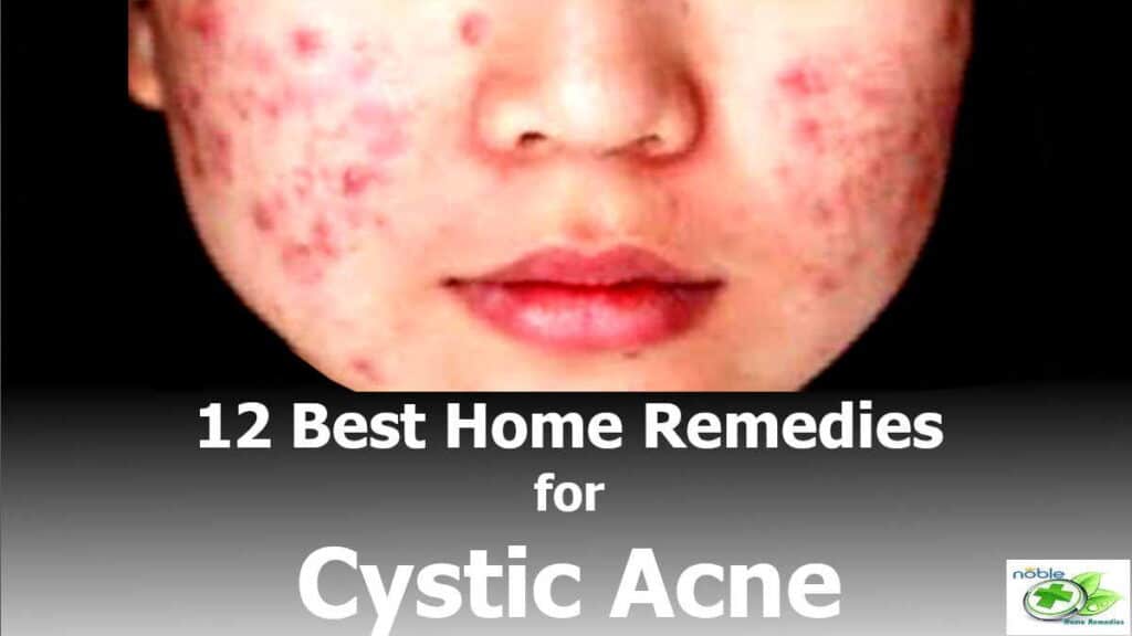 Best home remedies for cystic acne