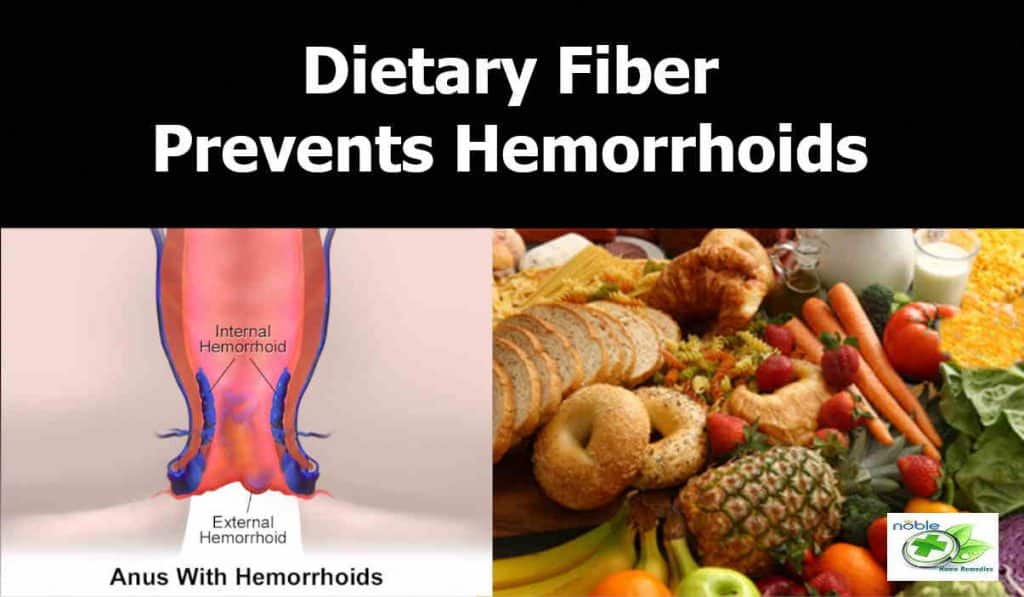 Intake of Dietary Fiber good for preventing development of hemorrhoids