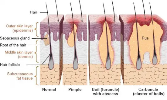 Different types of hair follicle infections that cause boils