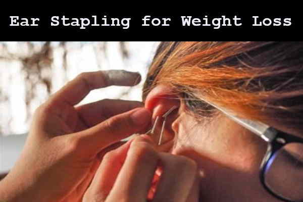 Chinese traditional acupuncture ear stapling for weight loss