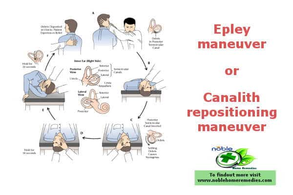 Epley maneuver or Canalith repositioning maneuver