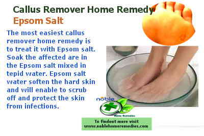 Epsom Salt - Callus remover home remedy