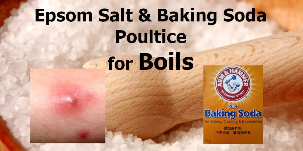 Epsom Salt Poultice to treat Boils  