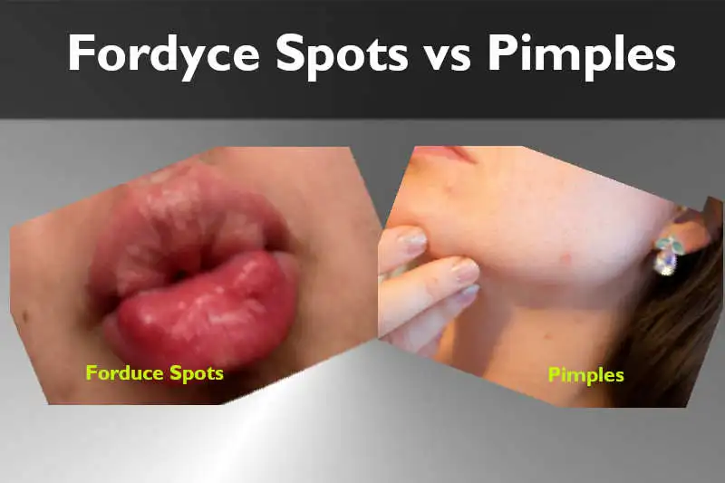 Fordyce Spots vs Pimples