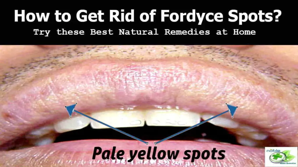 Natural remedies to get rid of Fordyce Spots on lip and genitals