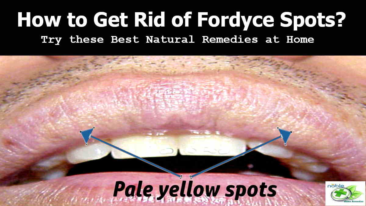 How to Get Rid of Fordyce Spots 5 Effortless Home Remedies