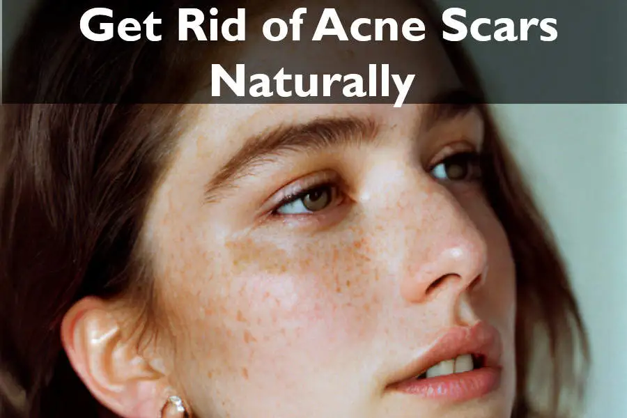 How to get rid of acne scars naturally