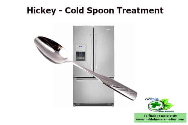 Cold metallic teaspoon from the refrigerator helps to get rid of hickey in one day 