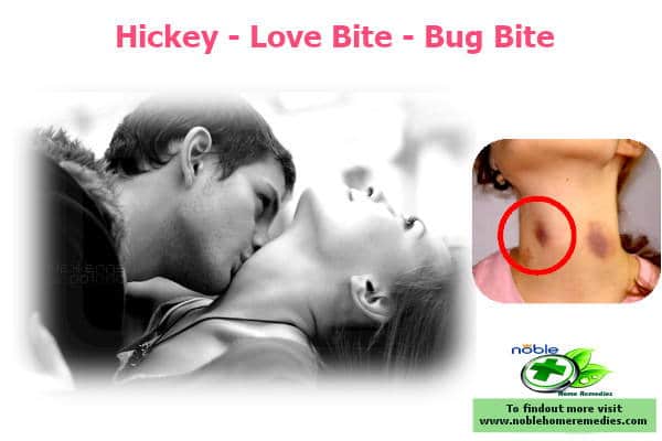 a man and woman kissing - How to get rid of a hickey fast