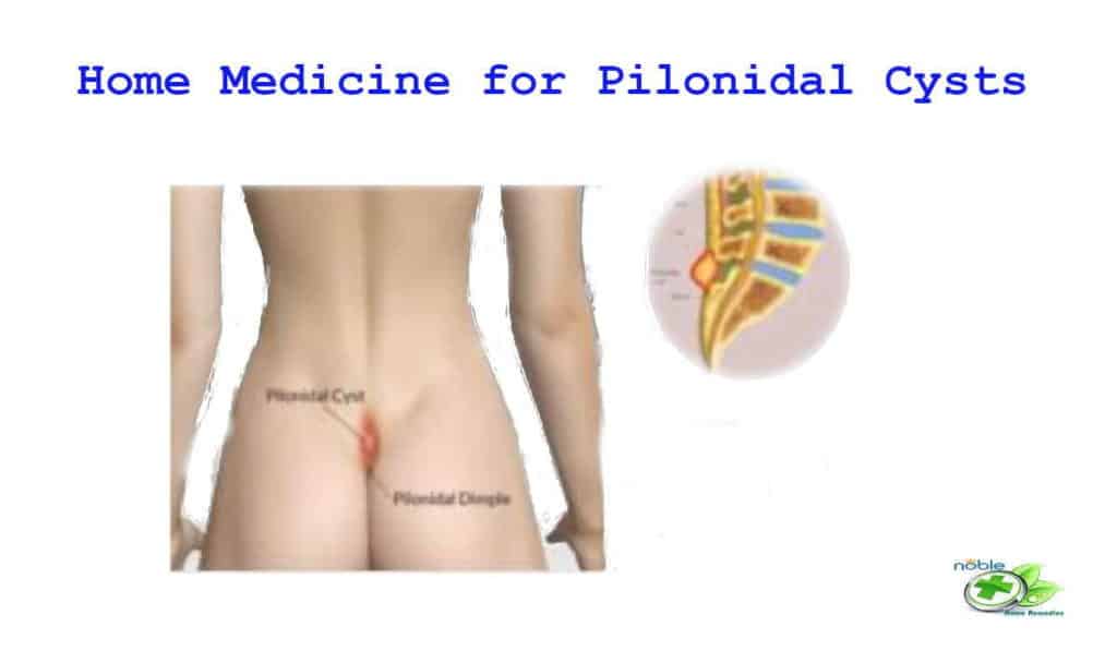 Pilonidal Cysts (Pilonidal Sinus) Home Medicine