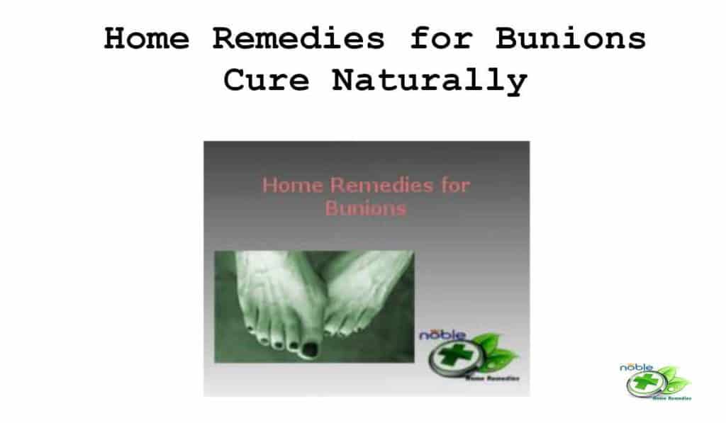 Home Remedies for Bunions