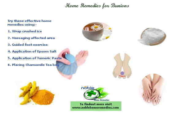 Home Remedies for Bunions