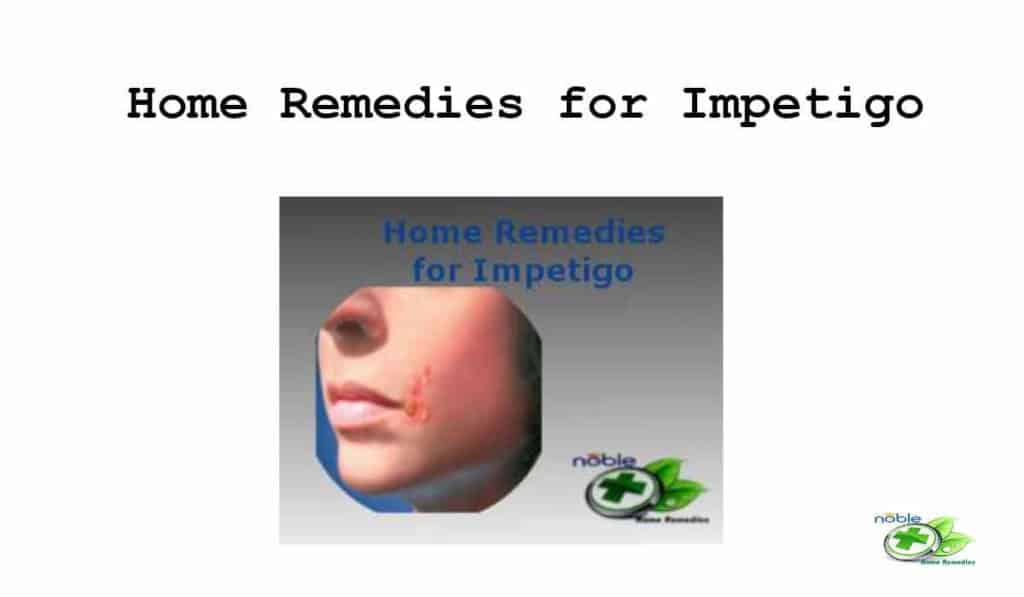 Home Remedies for Impetigo and Causes and Symptoms