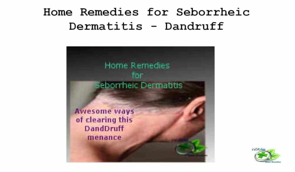 Top 7 Home Remedies For Seborrheic Dermatitis Dandruff