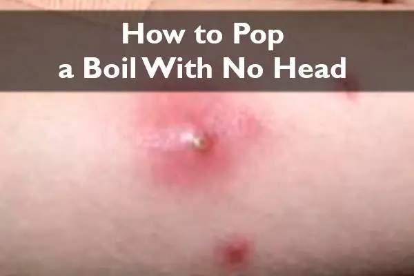 How to Pop a Boil With No Head