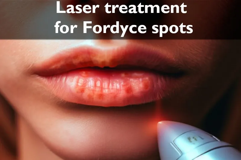 Laser treatment for Fordyce spots