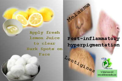 Lemon Juice for Dark Spots on Face