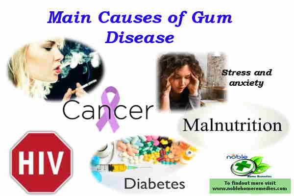 Main Causes of Gum Disease - Natural Treatment Gum Disease