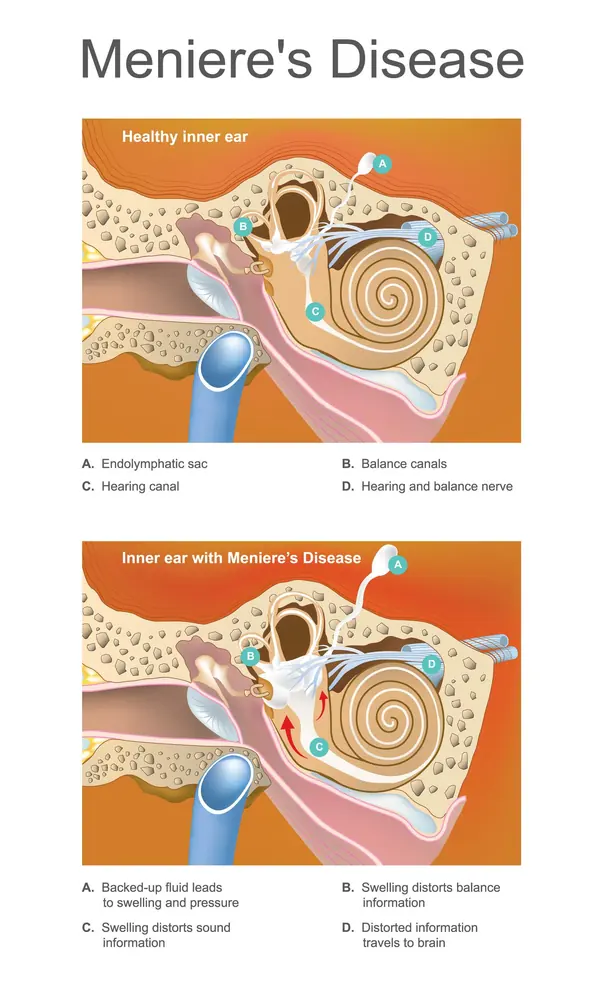 Meniers Disease - Vertigo