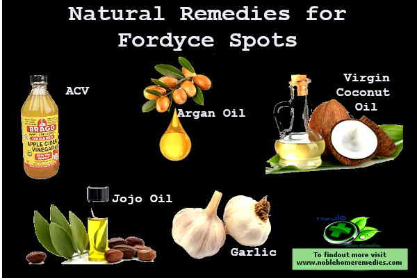 home remedies on how to get rid of Fordyce spots