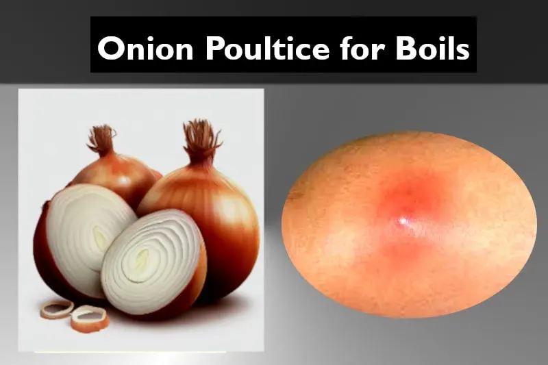 Onion Poultice for Boils natural remedy