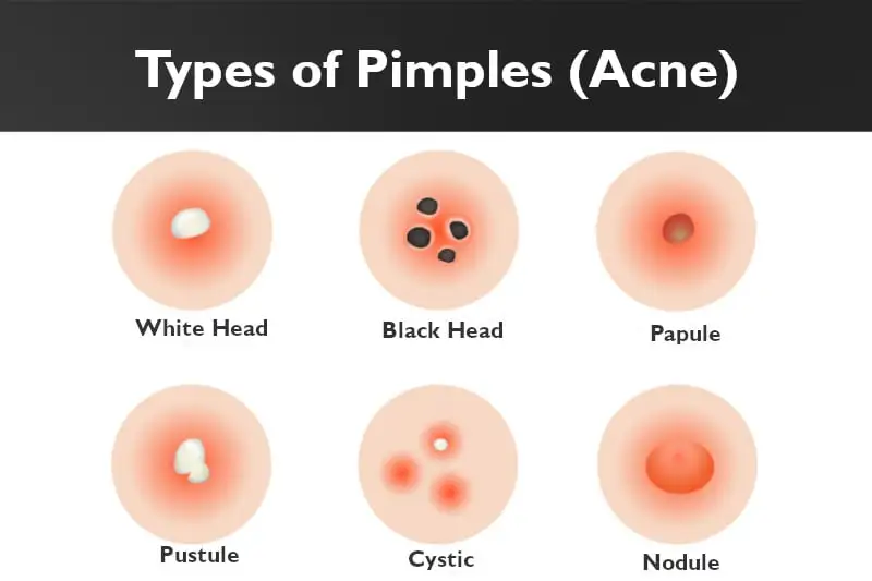 types of pimples or acne