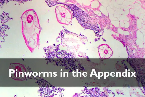 Pinworms in the Appendix