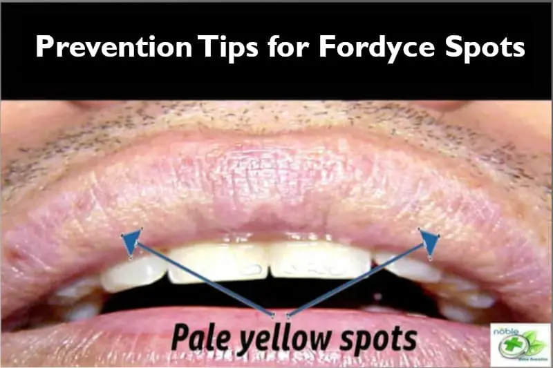 Proven Fordyce Spots Prevention tips