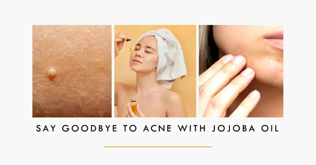 Jojoba Oil for Acne Skin