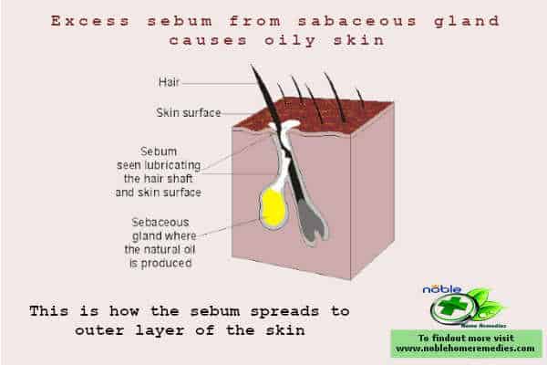 How the sebum spreads over the skin - excess sebum causes oily skin