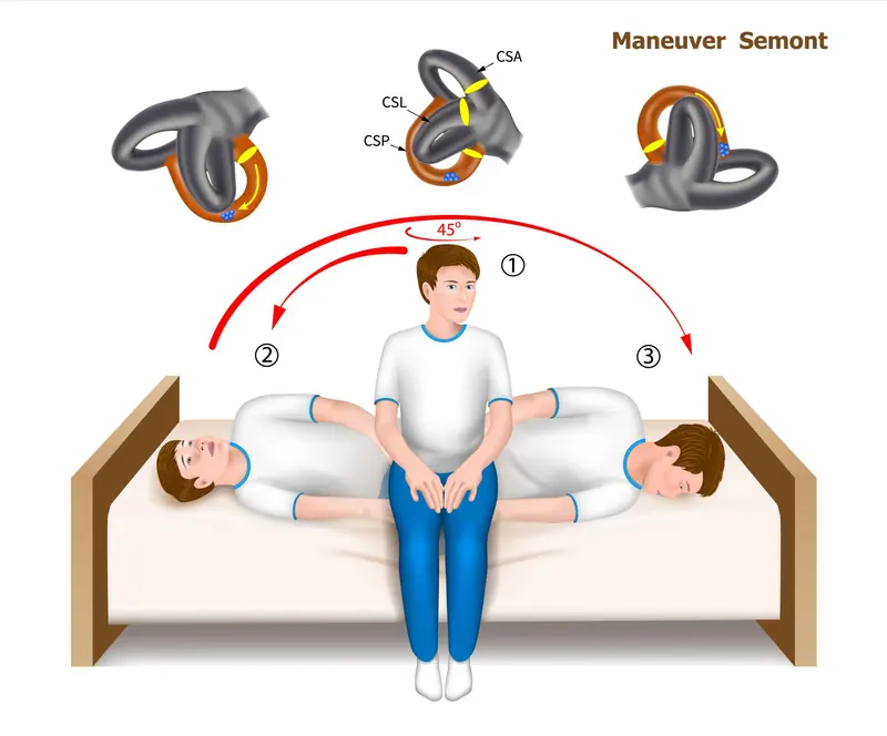 Semont-Toupet Maneuver