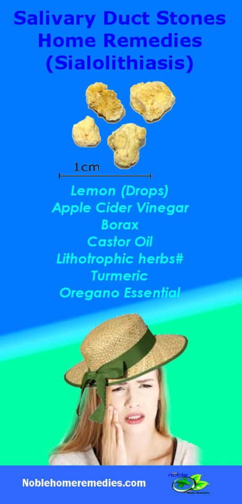 Sialolithiasis - Salivary Duct Stones Home Remedies