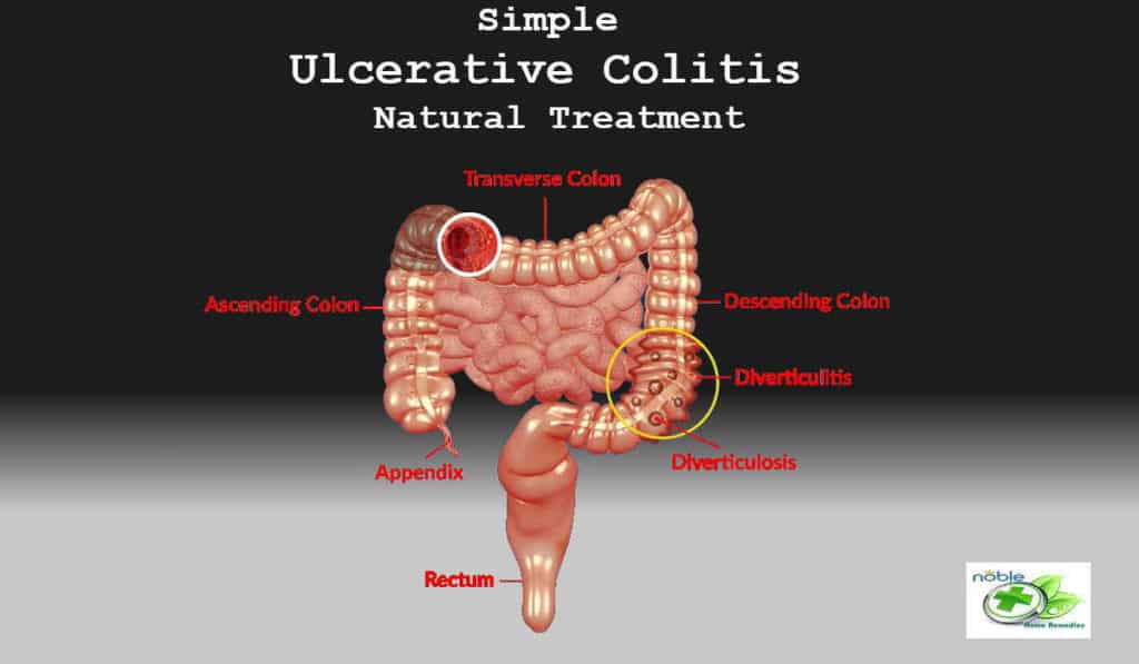 Ulcerative Colitis Natural Treatment