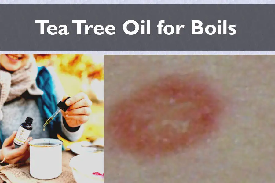 effective remedy - tea tree oil for boils