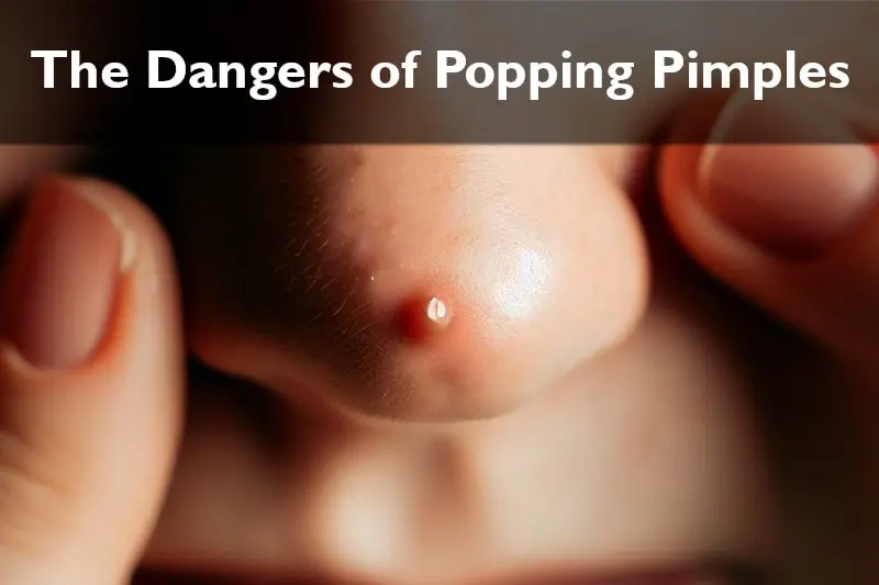 The Dangers of Popping Pimples and Why Popping Is Harmful